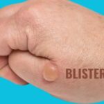 https://uktimepost.com/when-is-the-best-time-to-use-blisterata/